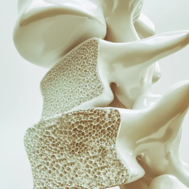 Osteoporosis image
